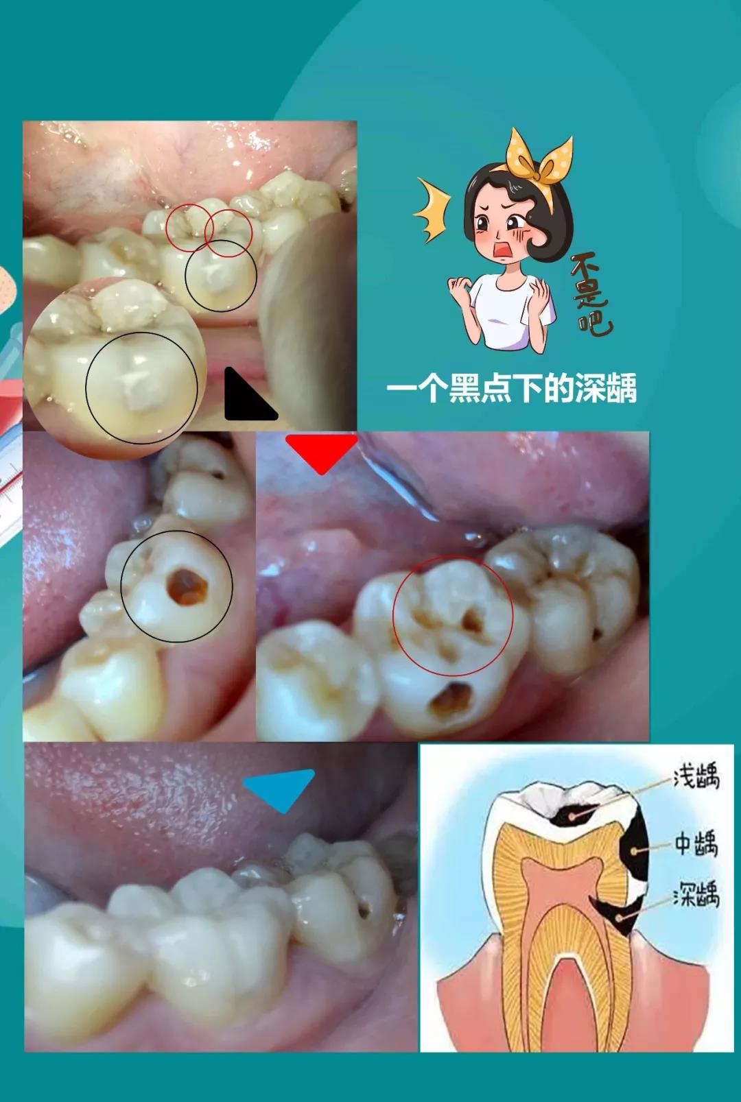 牙齿出现黑点？刷不掉怎么办？ - 知乎